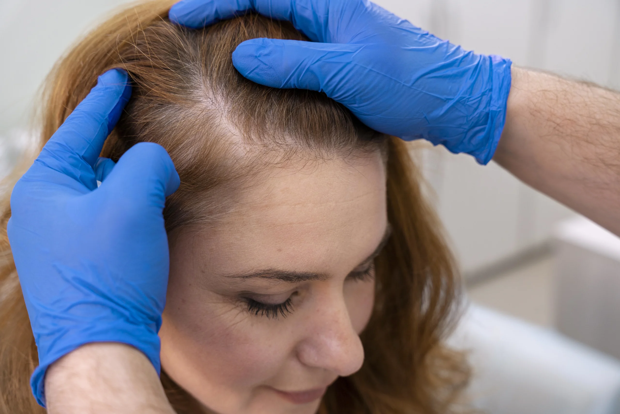 Hair loss