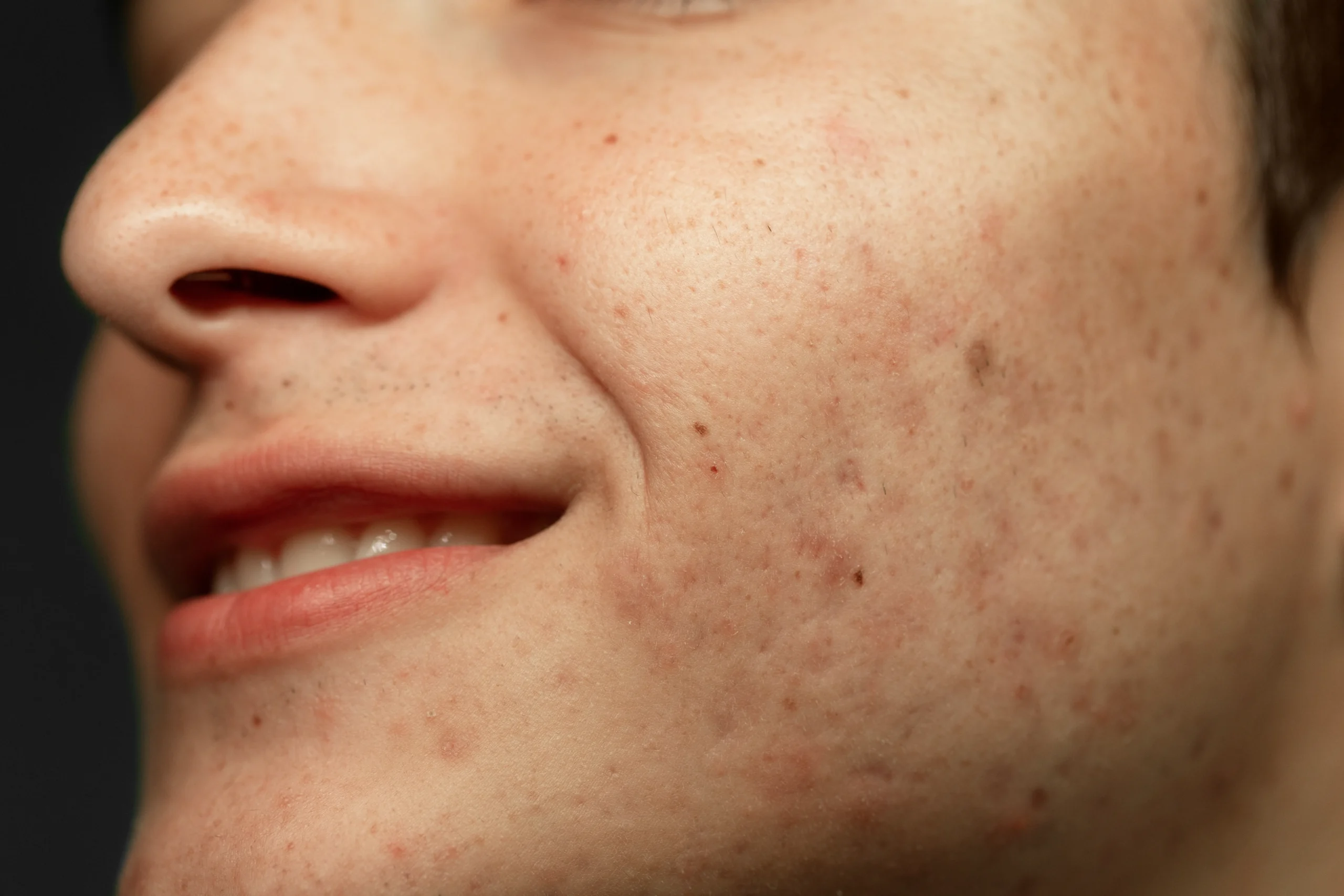 Melasma vs Hyperpigmentation